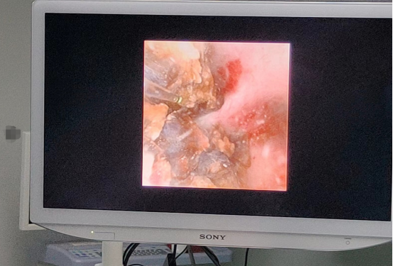 中山激光碎石，中山碎石医院，中山激光碎石医院