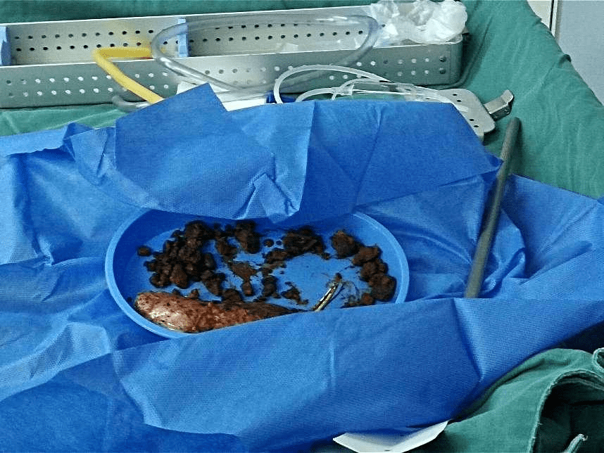 中山激光碎石,中山激光碎石费用