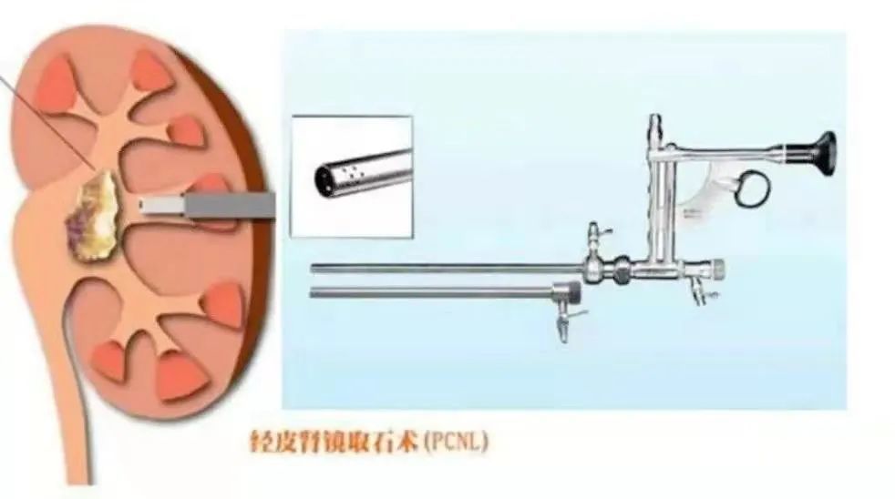 中山尿结石，中山尿结石多少钱，中山尿结石手术费一般多少钱