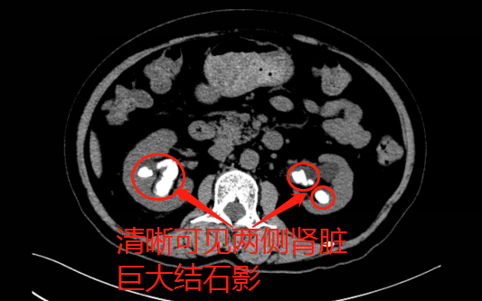 中山尿结石，中山尿结石碎石，中山尿结石碎石治疗