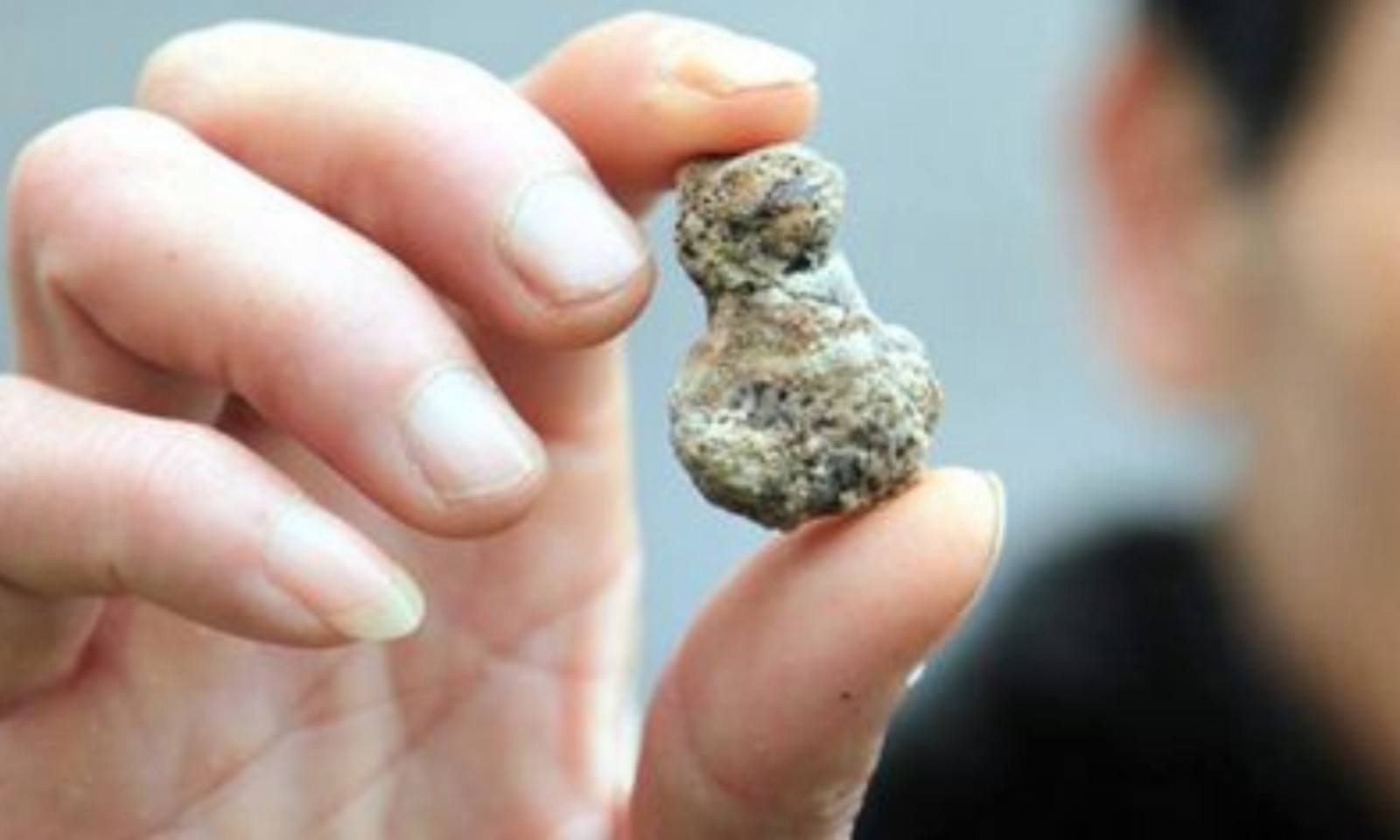中山泌尿结石医院，中山结石专科医院，中山泌尿外科肾结石专科医院