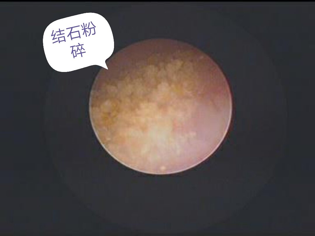 中山结石医院，中山结石专科医院，中山结石专科医院排名