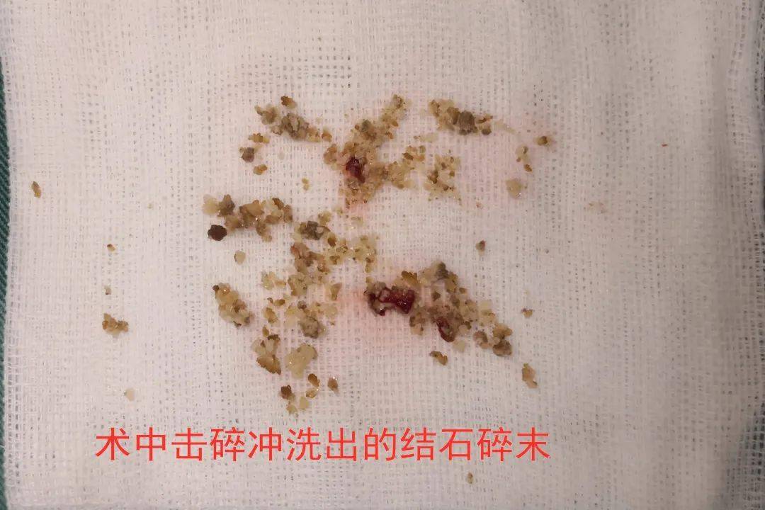 中山结石,中山结石医院,中山哪个医院治疗肾结石比较专业